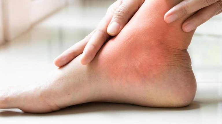 Ayak bileği burkulmasına ne iyi gelir?  Burkulmuş bir ayak bileği nasıl tedavi edilir?  Ayak bileği burkulmasına iyi gelen şeyler