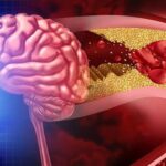 İnme Sonrası Hayata Dönüş: ‘Milattan Önce ve Sonrası Gibi’ Deneyimler!